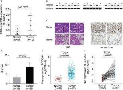 CDCA4 as a novel molecular biomarker of poor prognosis in patients with lung adenocarcinoma